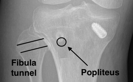 Fibula tunnel 2